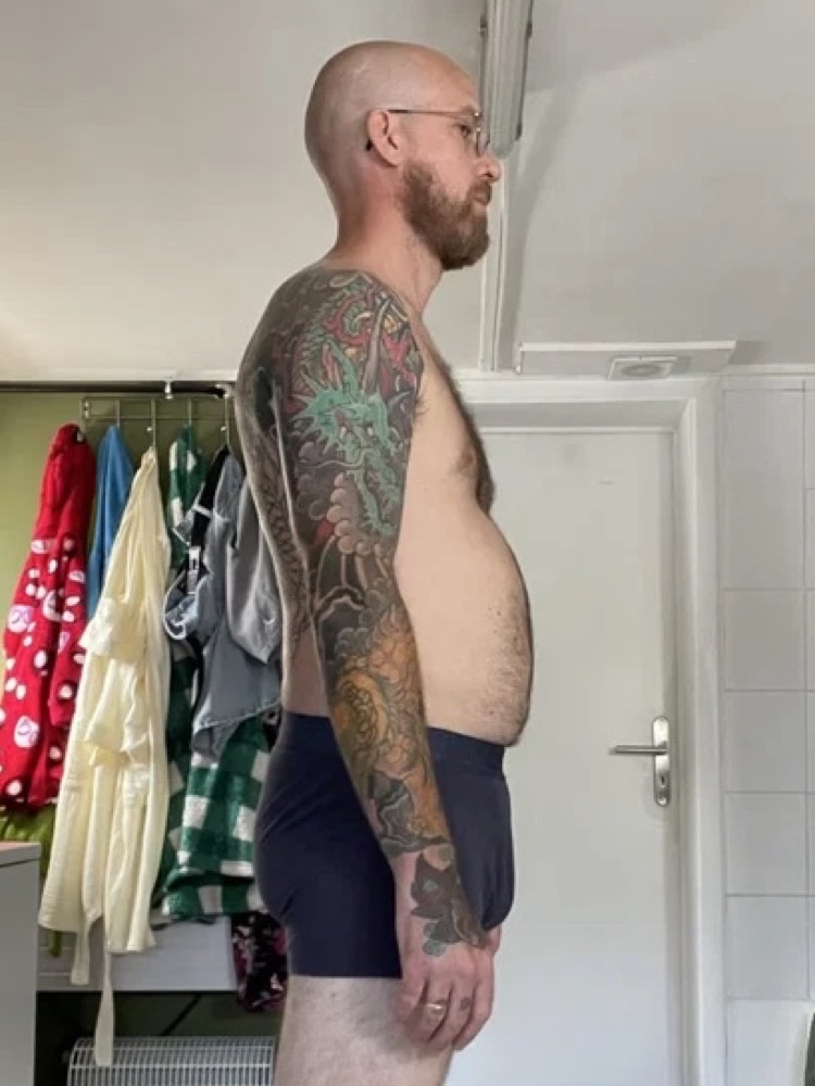 P., 43 · waist, in 5 weeks, Before